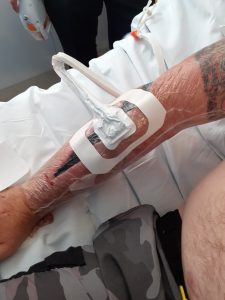 Unable to keep the wound closed a vacuum unit was used